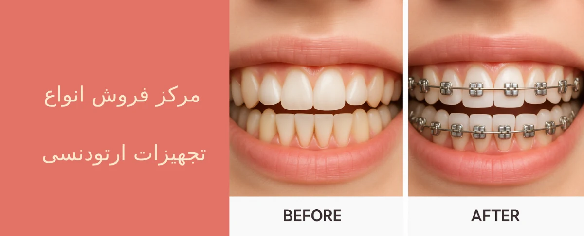 براکت ارتودنسی