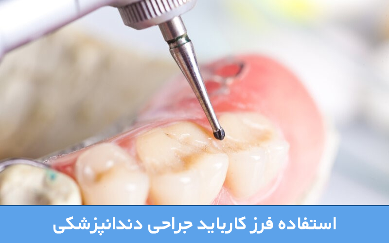 استفاده فرز کارباید جراحی دندانپزشکی